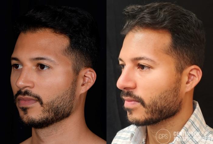 Rhinoplasty Case 379 Before & After Left Oblique | Chevy Chase & Annandale, Washington D.C. Metropolitan Area | Center for Plastic Surgery