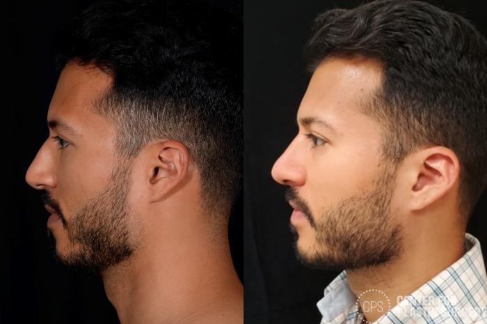 Rhinoplasty for Men Case 379 Before & After Left Side | Chevy Chase & Annandale, Washington D.C. Metropolitan Area | Center for Plastic Surgery