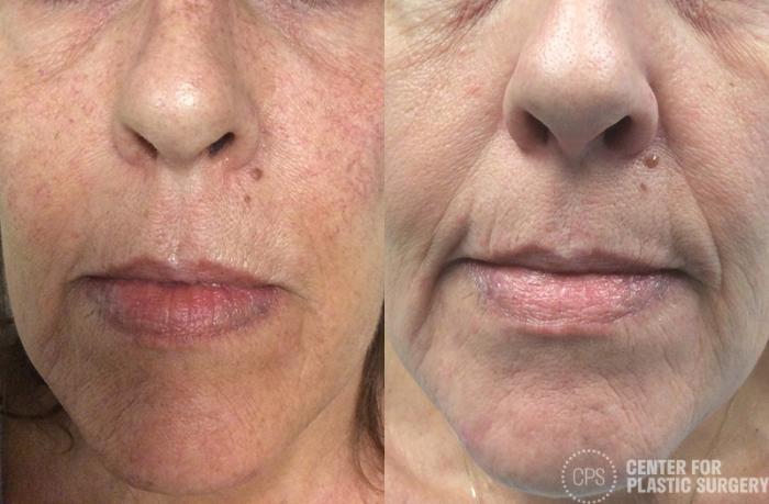 Skin Care Case 32 Before & After Front | Chevy Chase & Annandale, Washington D.C. Metropolitan Area | Center for Plastic Surgery
