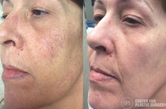 Skin Care Case 32 Before & After Left Oblique | Chevy Chase & Annandale, Washington D.C. Metropolitan Area | Center for Plastic Surgery