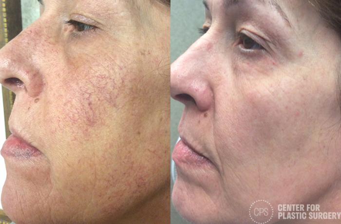 Skin Care Case 32 Before & After Left Side | Chevy Chase & Annandale, Washington D.C. Metropolitan Area | Center for Plastic Surgery