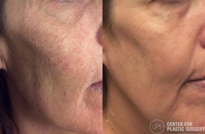 Skin Care Case 32 Before & After Right Oblique | Chevy Chase & Annandale, Washington D.C. Metropolitan Area | Center for Plastic Surgery