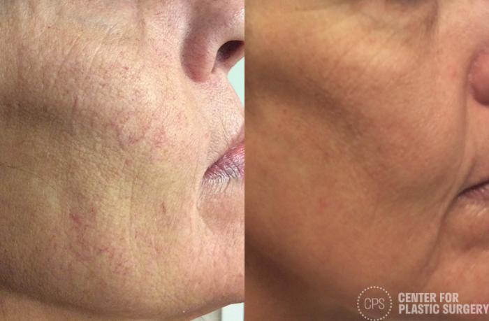 Skin Care Case 32 Before & After Right Side | Chevy Chase & Annandale, Washington D.C. Metropolitan Area | Center for Plastic Surgery