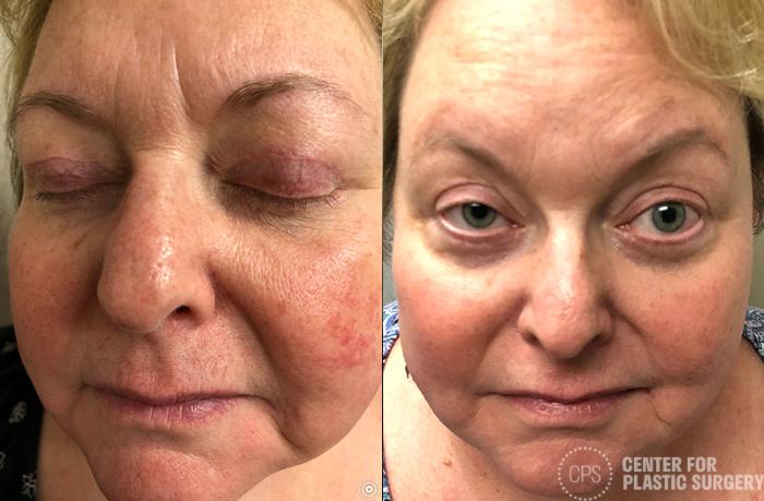 Skin Care Case 33 Before & After Front | Chevy Chase & Annandale, Washington D.C. Metropolitan Area | Center for Plastic Surgery