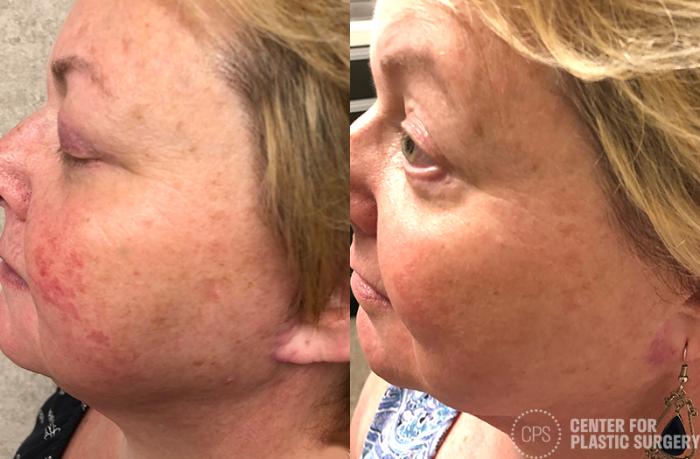 Skin Care Case 33 Before & After Left Side | Chevy Chase & Annandale, Washington D.C. Metropolitan Area | Center for Plastic Surgery