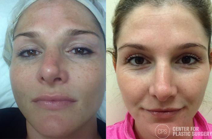 Skin Care Case 34 Before & After Front | Chevy Chase & Annandale, Washington D.C. Metropolitan Area | Center for Plastic Surgery