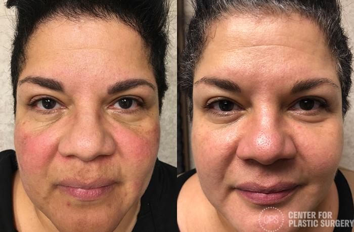 Skin Care Case 35 Before & After Front | Chevy Chase & Annandale, Washington D.C. Metropolitan Area | Center for Plastic Surgery