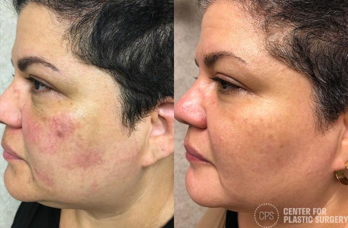 Skin Care Case 35 Before & After Left Oblique | Chevy Chase & Annandale, Washington D.C. Metropolitan Area | Center for Plastic Surgery