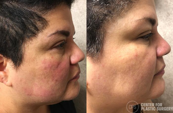 Skin Care Case 35 Before & After Right Side | Chevy Chase & Annandale, Washington D.C. Metropolitan Area | Center for Plastic Surgery