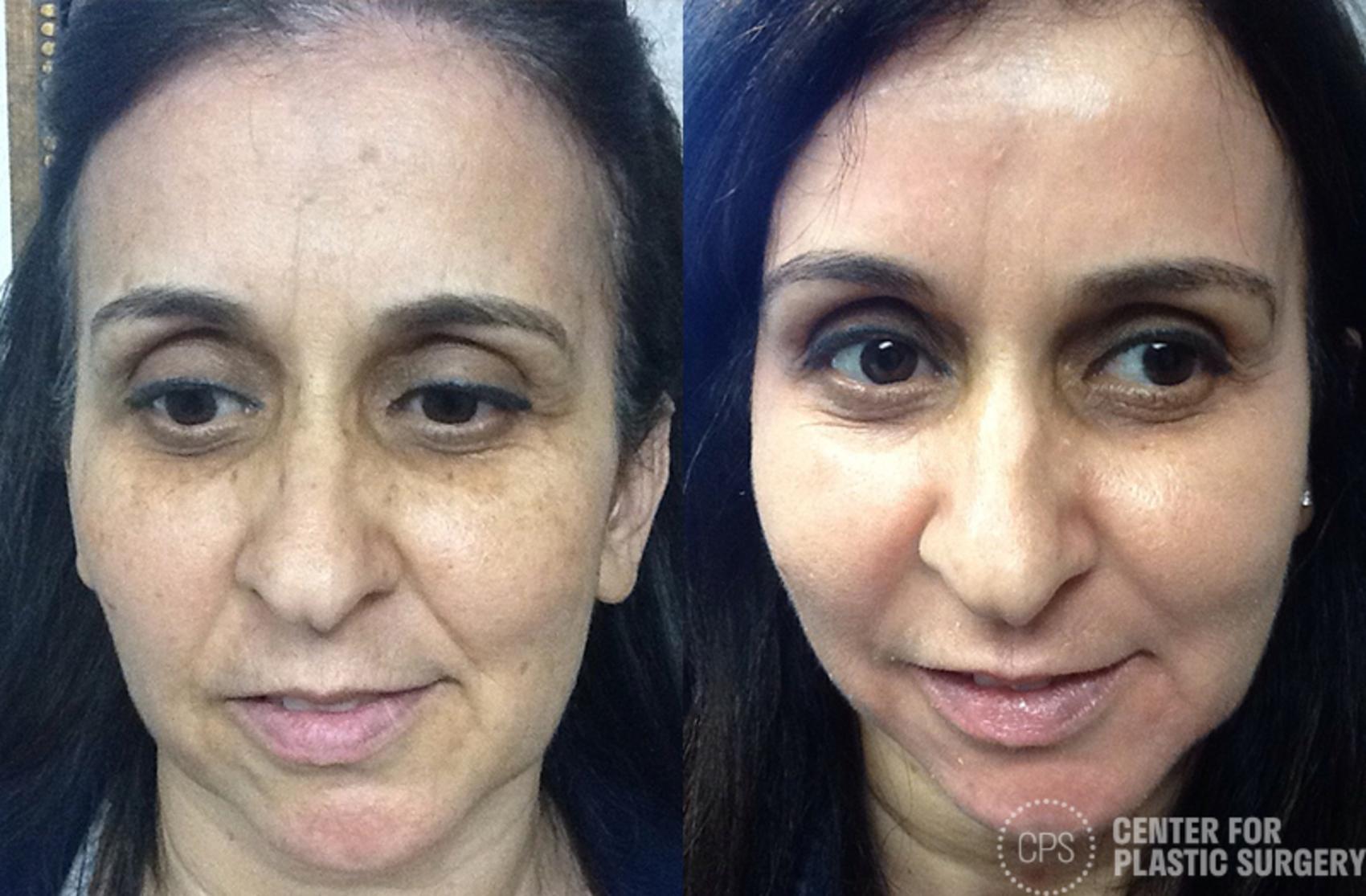 Skin Care Case 36 Before & After Front | Chevy Chase & Annandale, Washington D.C. Metropolitan Area | Center for Plastic Surgery