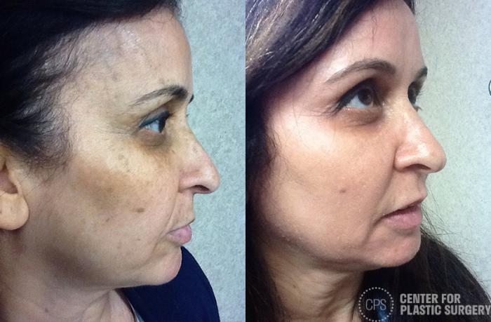Skin Care Case 36 Before & After Right Side | Chevy Chase & Annandale, Washington D.C. Metropolitan Area | Center for Plastic Surgery