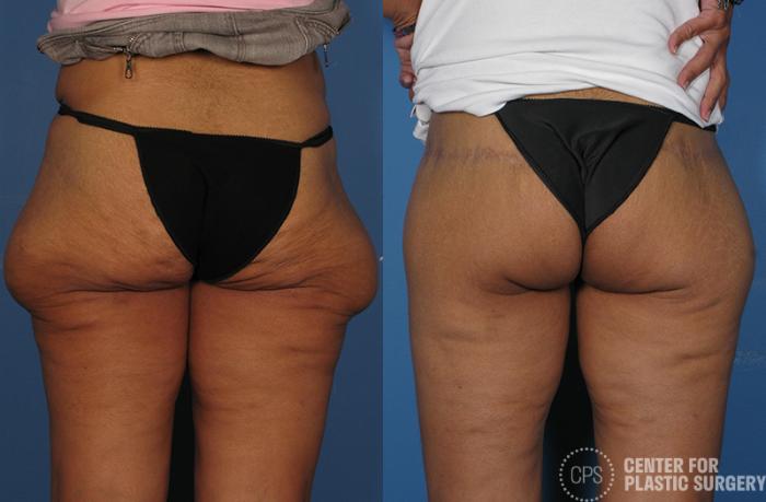 Thigh Lift Case 75 Before & After Back | Chevy Chase & Annandale, Washington D.C. Metropolitan Area | Center for Plastic Surgery