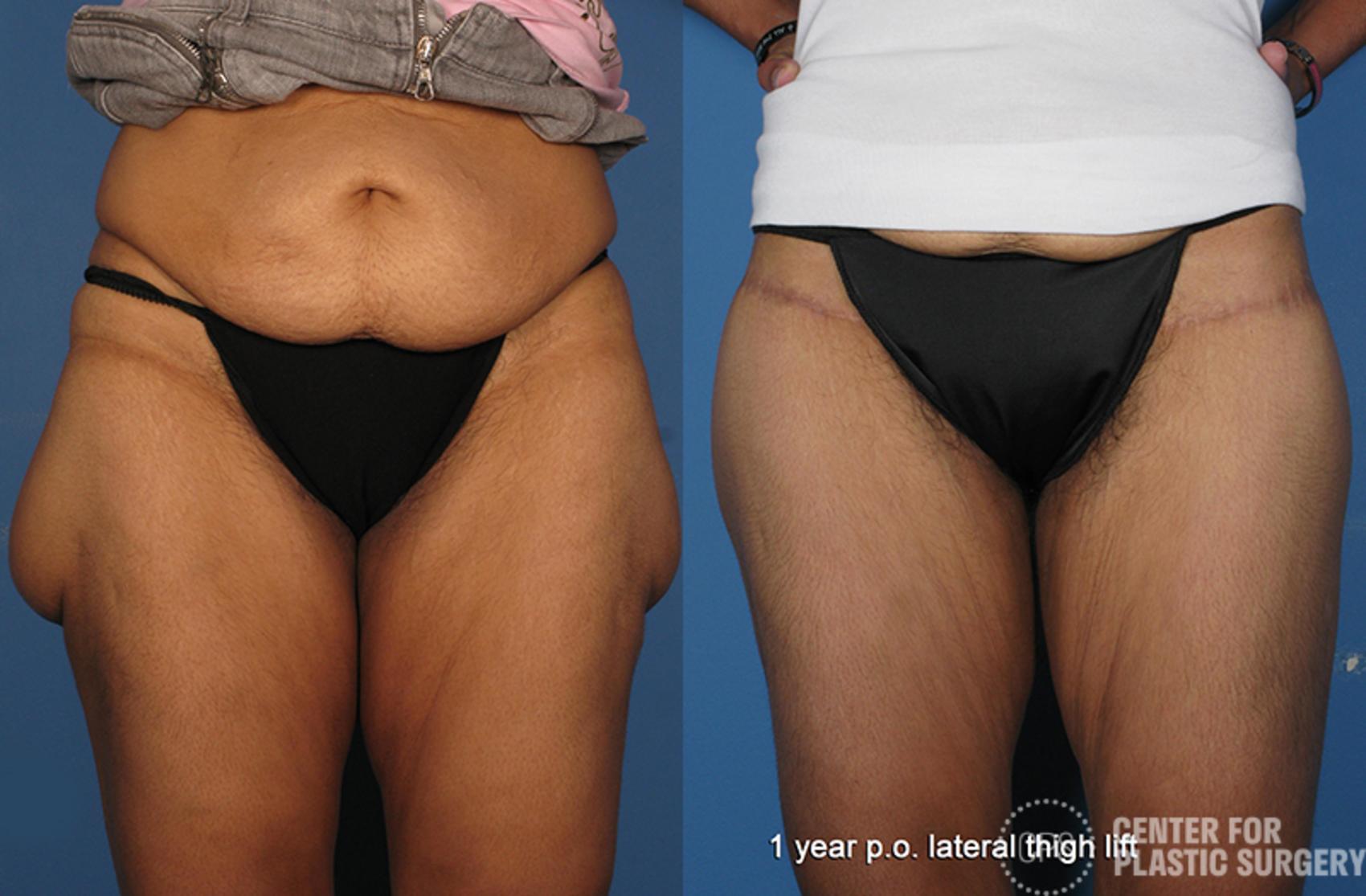 Thigh Lift Case 75 Before & After Front | Chevy Chase & Annandale, Washington D.C. Metropolitan Area | Center for Plastic Surgery