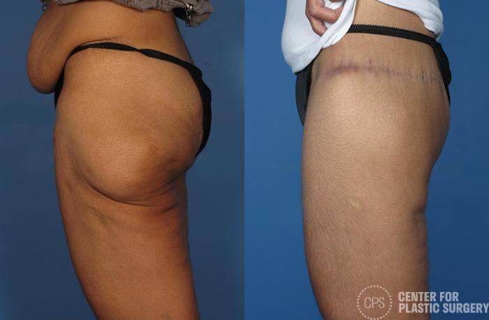 Thigh Lift Case 75 Before & After Left Side | Chevy Chase & Annandale, Washington D.C. Metropolitan Area | Center for Plastic Surgery