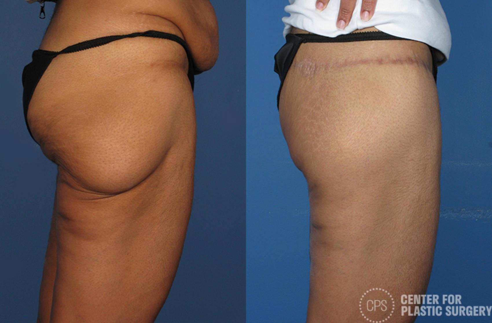 Thigh Lift Case 75 Before & After Right Side | Annandale, Washington D.C. Metropolitan Area | Center for Plastic Surgery