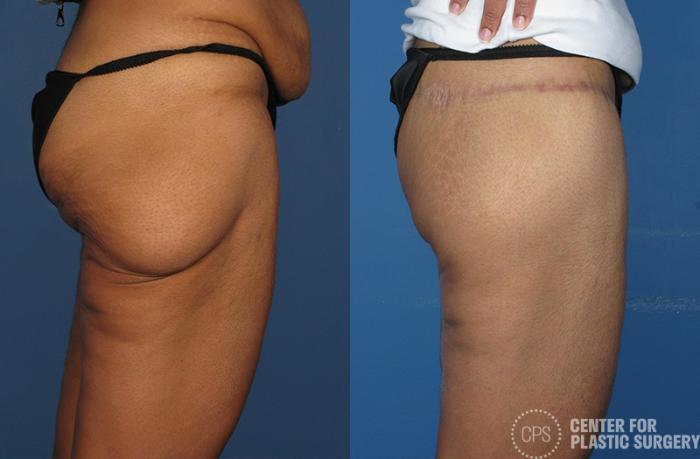 Thigh Lift Case 75 Before & After Right Side | Chevy Chase & Annandale, Washington D.C. Metropolitan Area | Center for Plastic Surgery