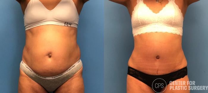 Liposuction Case 153 Before & After Front | Chevy Chase & Annandale, Washington D.C. Metropolitan Area | Center for Plastic Surgery