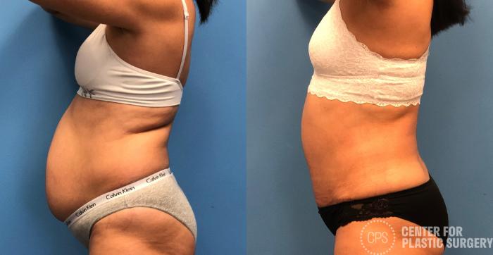 Tummy Tuck Case 153 Before & After Left Side | Chevy Chase & Annandale, Washington D.C. Metropolitan Area | Center for Plastic Surgery