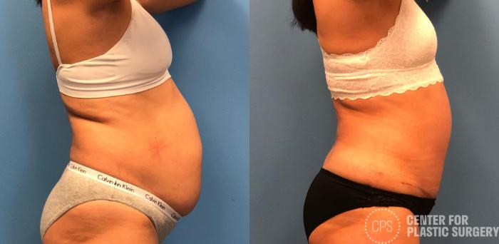 Tummy Tuck Case 153 Before & After Right Side | Chevy Chase & Annandale, Washington D.C. Metropolitan Area | Center for Plastic Surgery