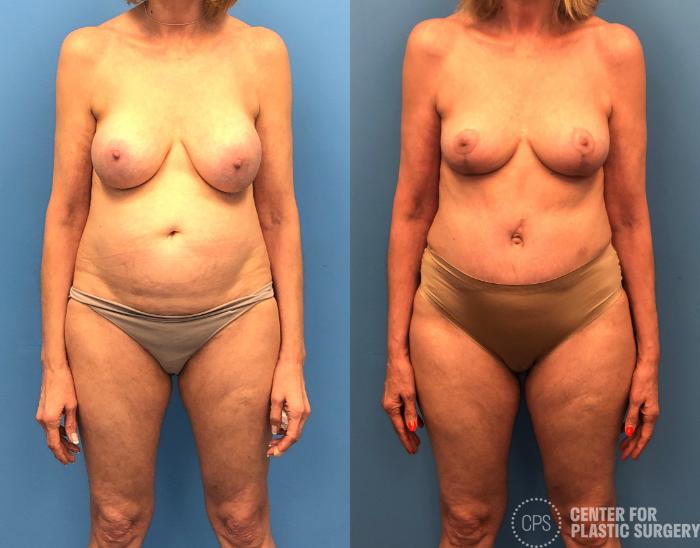Breast Lift Case 164 Before & After Front | Chevy Chase & Annandale, Washington D.C. Metropolitan Area | Center for Plastic Surgery