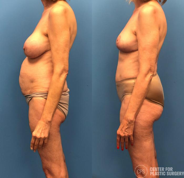 Liposuction Case 164 Before & After Left Side | Chevy Chase & Annandale, Washington D.C. Metropolitan Area | Center for Plastic Surgery