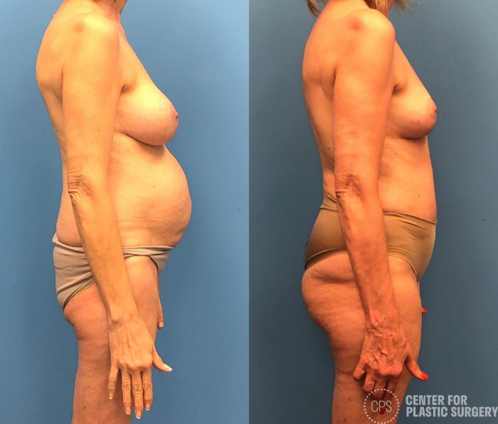Tummy Tuck Case 164 Before & After Right Side | Chevy Chase & Annandale, Washington D.C. Metropolitan Area | Center for Plastic Surgery