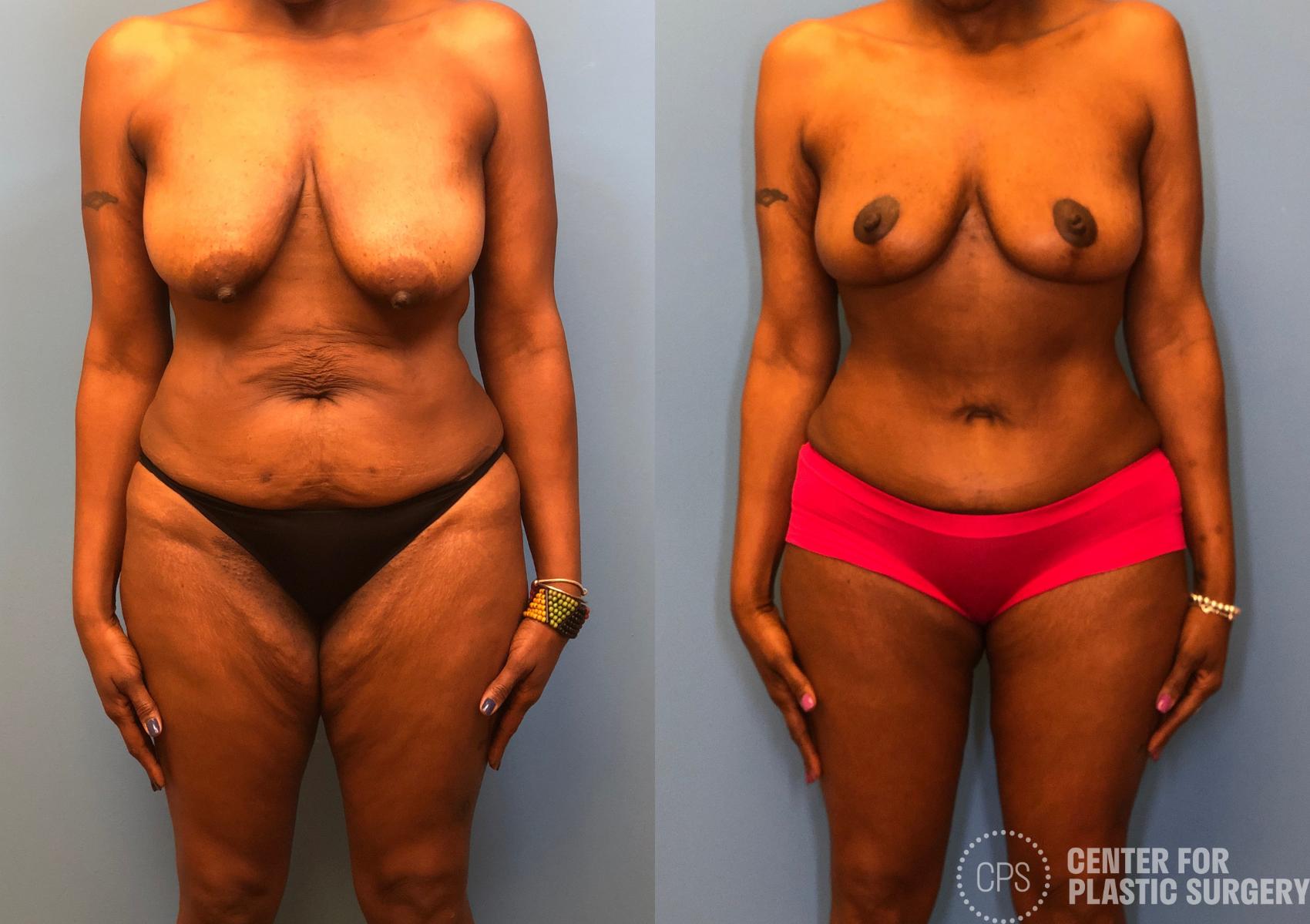 Thigh Lift Case 165 Before & After Front | Chevy Chase & Annandale, Washington D.C. Metropolitan Area | Center for Plastic Surgery