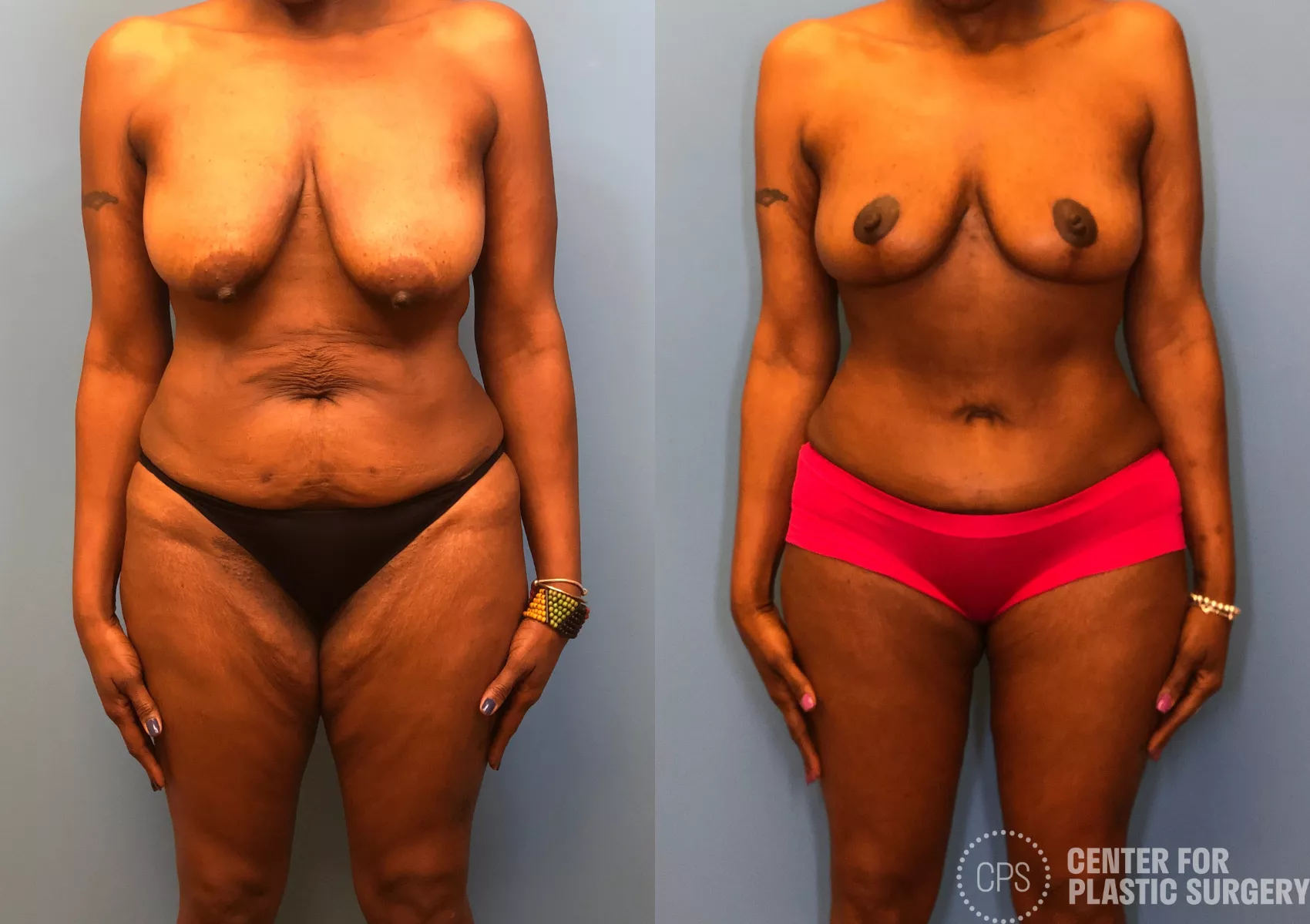 Tummy Tuck Case 165 Before & After Front | Annandale, Washington D.C. Metropolitan Area | Center for Plastic Surgery