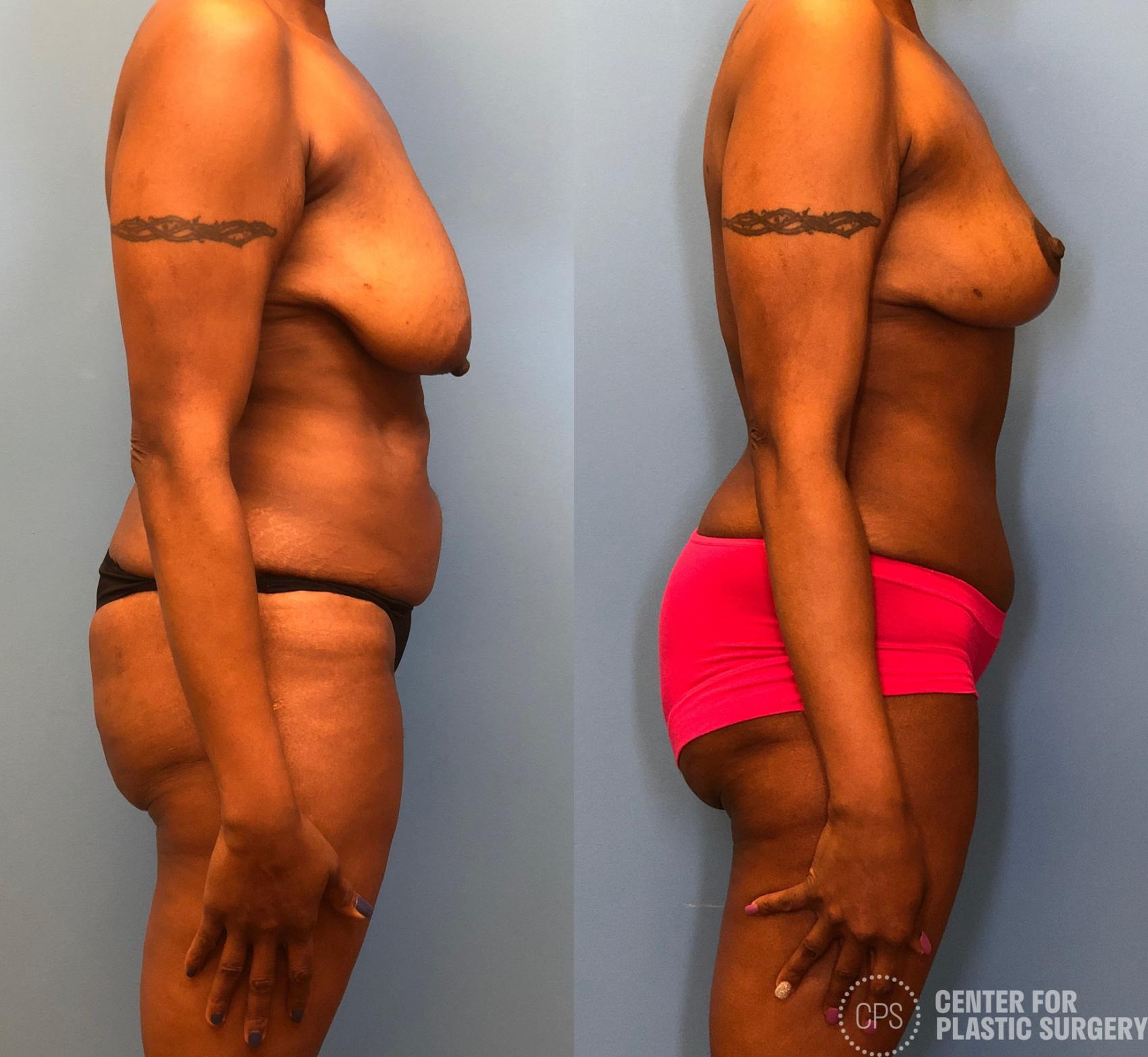 Tummy Tuck Case 165 Before & After Right Side | Annandale, Washington D.C. Metropolitan Area | Center for Plastic Surgery