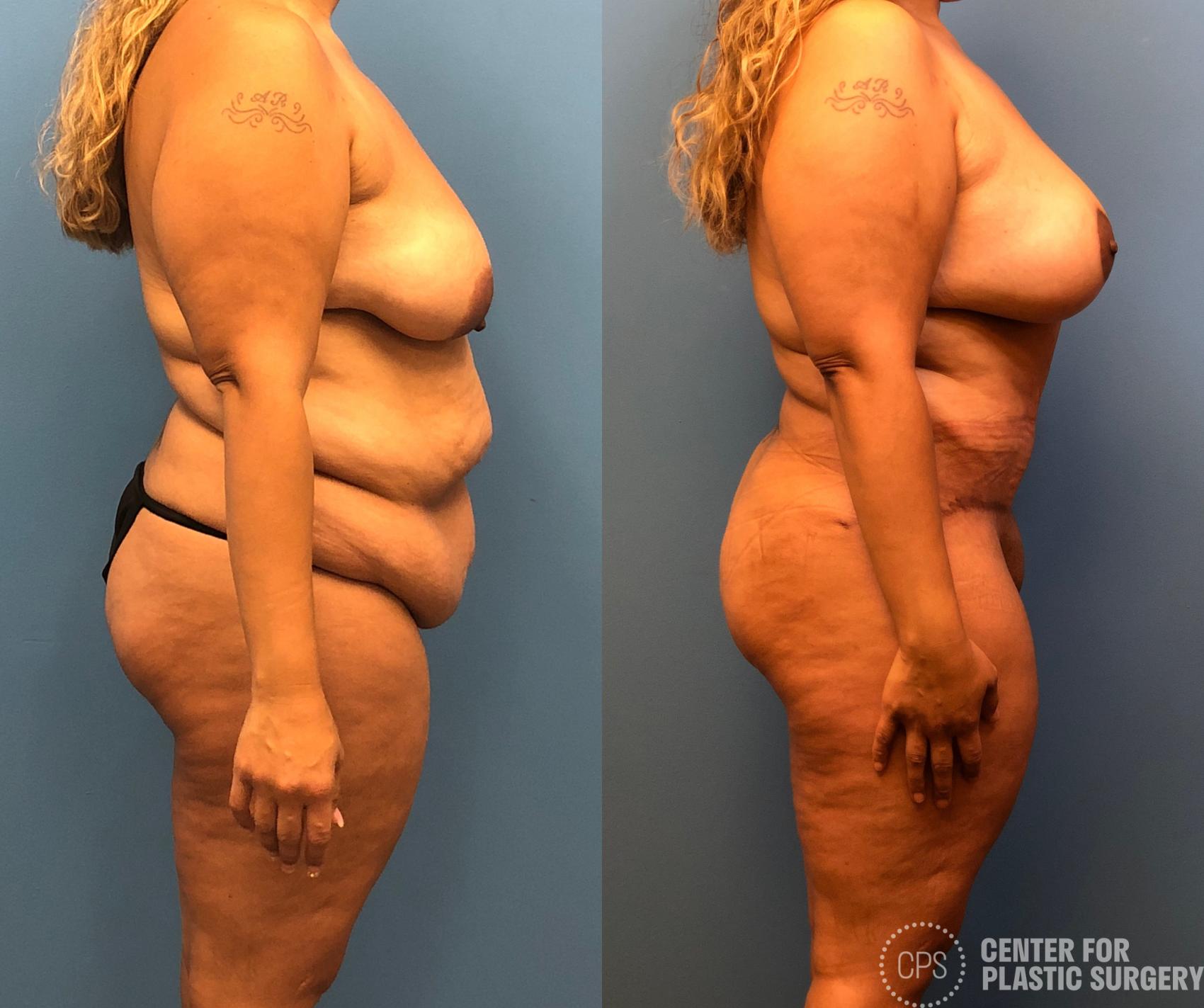 Tummy Tuck Case 179 Before & After Right Side | Annandale, Washington D.C. Metropolitan Area | Center for Plastic Surgery