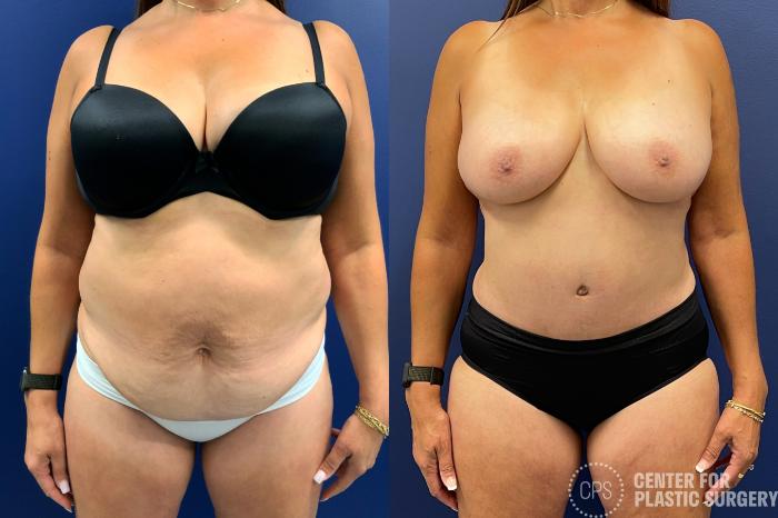 Tummy Tuck Case 204 Before & After Front | Chevy Chase & Annandale, Washington D.C. Metropolitan Area | Center for Plastic Surgery