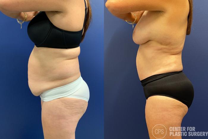 Tummy Tuck Case 204 Before & After Left Side | Chevy Chase & Annandale, Washington D.C. Metropolitan Area | Center for Plastic Surgery