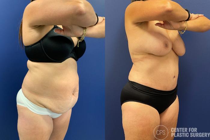 Tummy Tuck Case 204 Before & After Right Oblique | Chevy Chase & Annandale, Washington D.C. Metropolitan Area | Center for Plastic Surgery