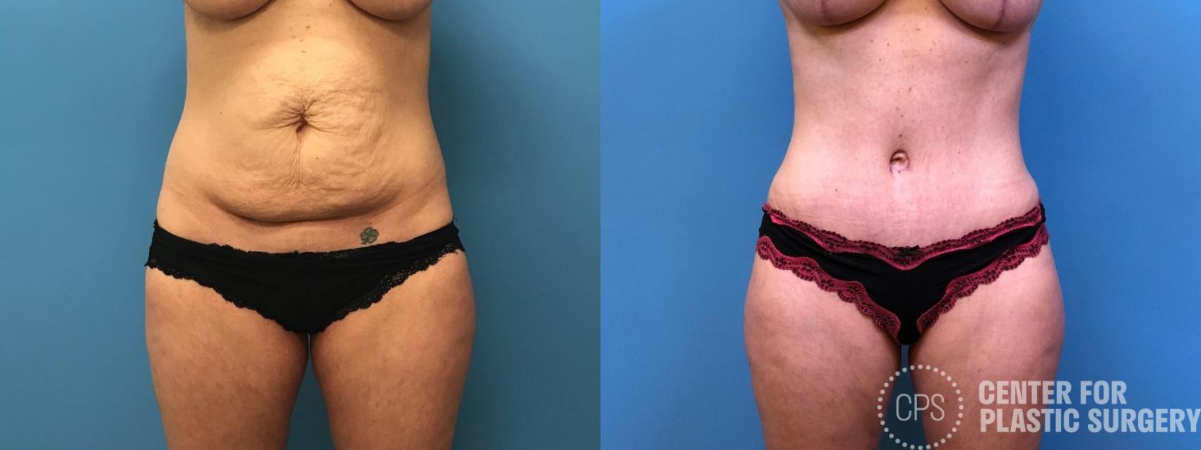 Tummy Tuck Case 244 Before & After Front | Chevy Chase & Annandale, Washington D.C. Metropolitan Area | Center for Plastic Surgery