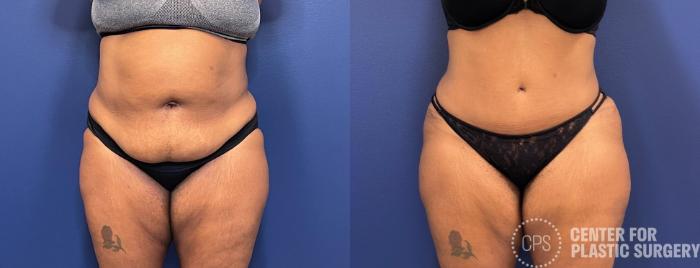 Liposuction Case 245 Before & After Front | Chevy Chase & Annandale, Washington D.C. Metropolitan Area | Center for Plastic Surgery