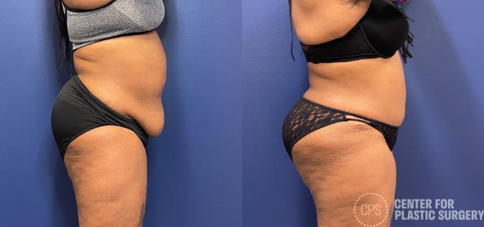 Liposuction Case 245 Before & After Right Side | Chevy Chase & Annandale, Washington D.C. Metropolitan Area | Center for Plastic Surgery