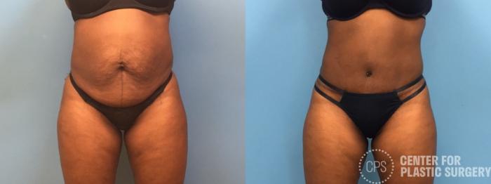 Liposuction Case 246 Before & After Front | Chevy Chase & Annandale, Washington D.C. Metropolitan Area | Center for Plastic Surgery