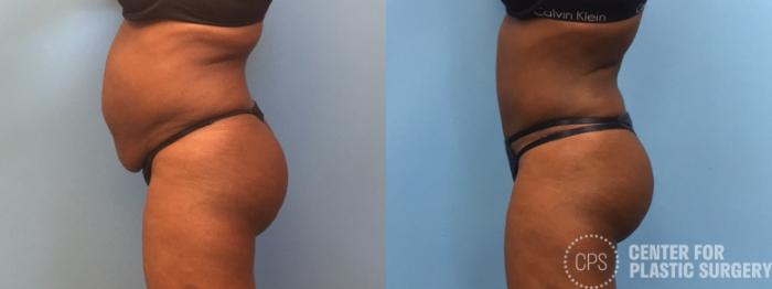 Tummy Tuck Case 246 Before & After Left Side | Chevy Chase & Annandale, Washington D.C. Metropolitan Area | Center for Plastic Surgery