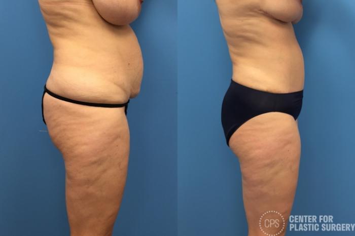 Liposuction Case 248 Before & After Right Side | Chevy Chase & Annandale, Washington D.C. Metropolitan Area | Center for Plastic Surgery