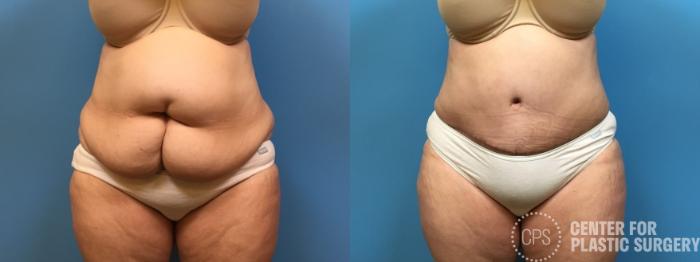 Tummy Tuck Case 249 Before & After Front | Chevy Chase & Annandale, Washington D.C. Metropolitan Area | Center for Plastic Surgery