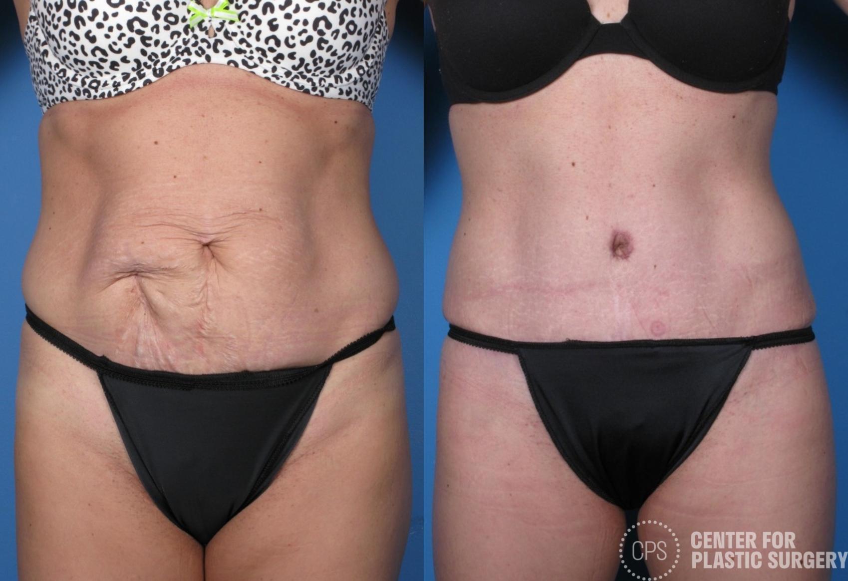 Tummy Tuck Case 250 Before & After Front | Chevy Chase & Annandale, Washington D.C. Metropolitan Area | Center for Plastic Surgery