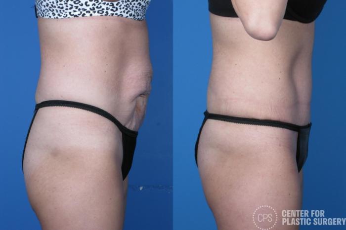 Tummy Tuck Case 250 Before & After Right Side | Chevy Chase & Annandale, Washington D.C. Metropolitan Area | Center for Plastic Surgery