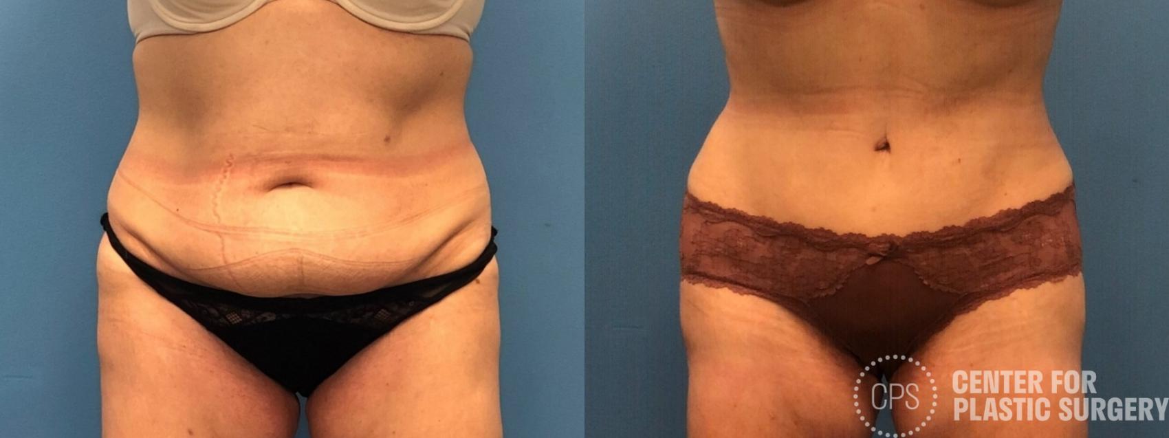 Tummy Tuck Case 251 Before & After Front | Chevy Chase & Annandale, Washington D.C. Metropolitan Area | Center for Plastic Surgery