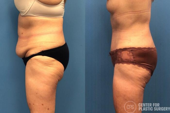 Tummy Tuck Case 251 Before & After Left Side | Chevy Chase & Annandale, Washington D.C. Metropolitan Area | Center for Plastic Surgery