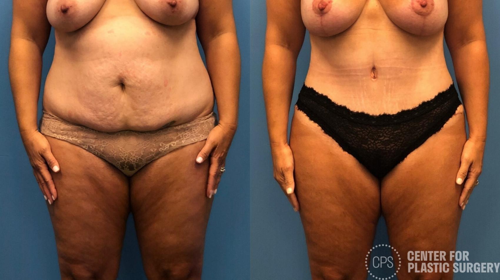 Tummy Tuck Case 252 Before & After Front | Chevy Chase & Annandale, Washington D.C. Metropolitan Area | Center for Plastic Surgery