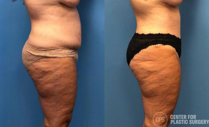 Tummy Tuck Case 252 Before & After Right Side | Chevy Chase & Annandale, Washington D.C. Metropolitan Area | Center for Plastic Surgery