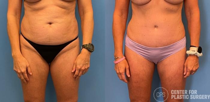 Tummy Tuck Case 253 Before & After Front | Chevy Chase & Annandale, Washington D.C. Metropolitan Area | Center for Plastic Surgery