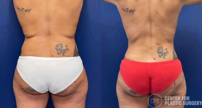 Tummy Tuck Case 254 Before & After Back | Chevy Chase & Annandale, Washington D.C. Metropolitan Area | Center for Plastic Surgery