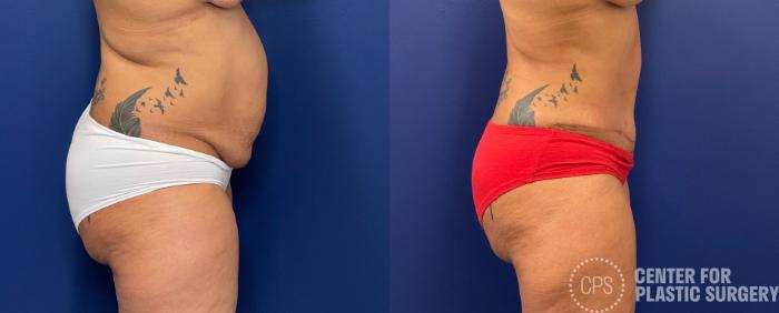 Tummy Tuck Case 254 Before & After Right Side | Chevy Chase & Annandale, Washington D.C. Metropolitan Area | Center for Plastic Surgery