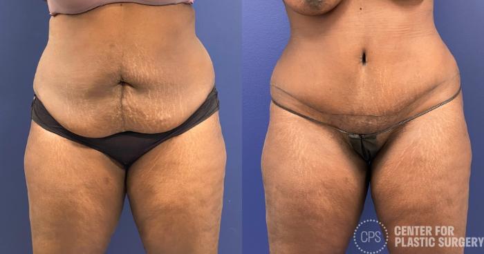 Tummy Tuck Case 257 Before & After Front | Chevy Chase & Annandale, Washington D.C. Metropolitan Area | Center for Plastic Surgery